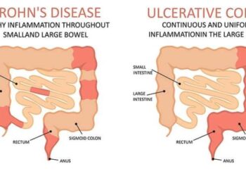 Crohn's Disease | An Ultimate Guide (Symptoms, Diet, Causes, Treatment)