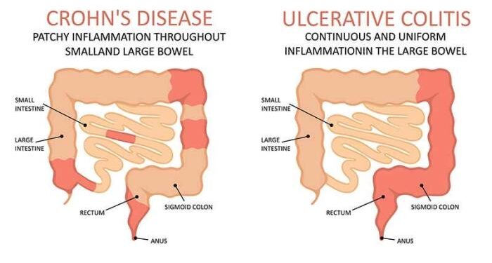 Crohn's Disease | An Ultimate Guide (Symptoms, Diet, Causes, Treatment)