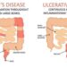 Crohn's Disease | An Ultimate Guide (Symptoms, Diet, Causes, Treatment)